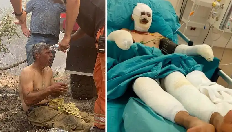 Orman İşçisinin "Yanıyorum" Feryadı: Sağlık Durumu ve Tedavi Süreci